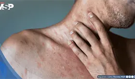 Estos son los nueve factores que podr&iacute;an desencadenar la urticaria cr&oacute;nica, seg&uacute;n estudio