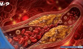 Gu&iacute;as de colesterol recomiendan pruebas desde los 10 a&ntilde;os para prevenir enfermedades de coraz&oacute;n