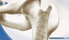 Desarrollan hidrogel inyectable que aumenta densidad &oacute;sea y reduce riesgo de fracturas en osteoporosis