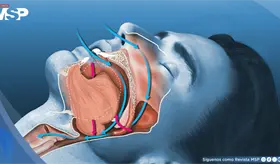 Desarrollan implante que mejora la apnea del sue&ntilde;o en 58 % de pacientes intolerantes a mascarilla CPAP