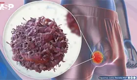 Bulto indoloro en el test&iacute;culo y dolor lumbar: Principales se&ntilde;ales de alerta del c&aacute;ncer testicular