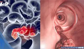 Terapia anti-HER2 logra respuesta completa en la mitad de pacientes con c&aacute;ncer rectal avanzado