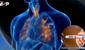 Agonistas GLP-1 reducen exacerbaciones del asma en adultos con sobrepeso sin diabetes: Estudio 