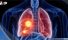 Desarrollan sensor &oacute;ptico que detecta c&aacute;ncer de pulm&oacute;n en sangre antes que los estudios de imagen