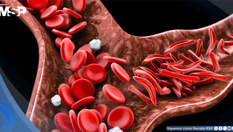 Nuevo tratamiento oral reduce en 27% las crisis de dolor en pacientes con anemia falciforme Nuevo tratamiento oral reduce en 27% las crisis de dolor en pacientes con anemia falciforme