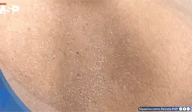 Picaz&oacute;n intensa nocturna, resequedad y lesiones cut&aacute;neas recurrentes revelan dermatitis at&oacute;pica moderada