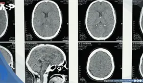 Desarrollan IA que reduce hasta un 90% el tiempo de las resonancias magn&eacute;ticas cerebrales