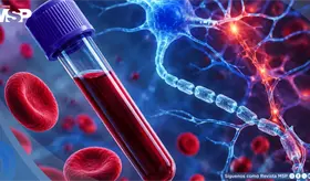Prote&iacute;nas en la sangre podr&iacute;an anticipar la esclerosis m&uacute;ltiple m&aacute;s de una d&eacute;cada antes del diagn&oacute;stico
