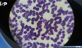 Seis meses de cansancio ocultaban una anemia asociada a enfermedad renal cr&oacute;nica
