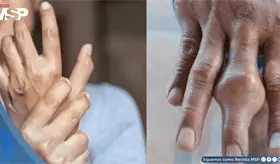 Rigidez matutina y dolor articular progresivo revelan artritis reumatoide activa en mujer de mediana edad
