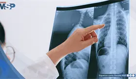 Dolor en el hombro: Posible se&ntilde;al temprana de c&aacute;ncer de pulm&oacute;n; 80% se detecta tarde