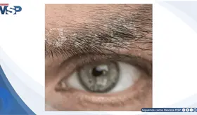 Dermatitis Seborreica: Placas Eritematoescamosas en Regi&oacute;n Facial y Cuero Cabelludo en Paciente Masculino