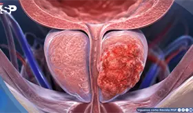 C&aacute;ncer de pr&oacute;stata en Colombia: 40% de pacientes con met&aacute;stasis, 8 veces m&aacute;s que en pa&iacute;ses desarrollados