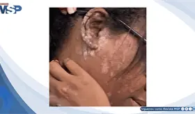 Lesiones en rostro y regi&oacute;n retroauricular revelan psoriasis cr&oacute;nica en paciente joven