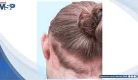 Descamaci&oacute;n intensa y picaz&oacute;n persistente en el cuero cabelludo revelan dermatitis seborreica cr&oacute;nica