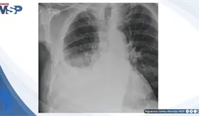 Disnea progresiva y dolor tor&aacute;cico revelan derrame pleural masivo en paciente adulto con neumon&iacute;a