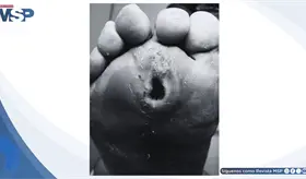 &Uacute;lcera Plantar Indolora Revela Pie Diab&eacute;tico Neurop&aacute;tico en Paciente con Diabetes Mellitus Tipo 2