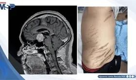 Aumento de peso y debilidad muscular revelan enfermedad de Cushing por adenoma hipofisario