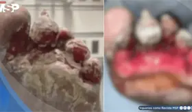 Lesi&oacute;n en el pie evoluciona a infecci&oacute;n por la bacteria Pseudomonas aeruginosa resistente a tratamiento
