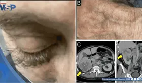 Crecimiento anormal de pesta&ntilde;as como se&ntilde;al inicial de un carcinoma renal metast&aacute;sico