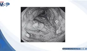 Caso cl&iacute;nico de amebiasis intestinal por Entamoeba histolytica.