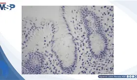 Helicobacter pylori: infecci&oacute;n causa gastritis cr&oacute;nica y &uacute;lcera duodenal en paciente de 46 a&ntilde;os