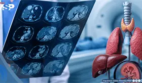 Cuatro tipos de c&aacute;ncer que suelen descubrirse de forma inesperada en estudios m&eacute;dicos