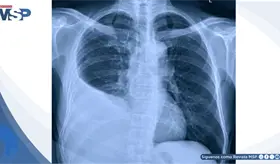 Dolor tor&aacute;cico y dificultad para respirar: as&iacute; se manifest&oacute; un derrame pleural complicado por neumon&iacute;a