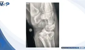 Fractura de Colles en paciente de 68 a&ntilde;os tras ca&iacute;da sobre mano extendida