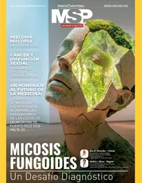 Micosis Fungoides Un Desafio Diagnostico