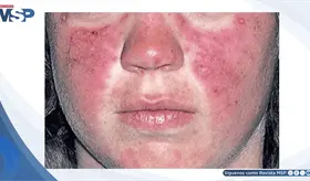 Erupci&oacute;n facial fotosensible, artritis y fatiga revelan un caso de lupus sist&eacute;mico