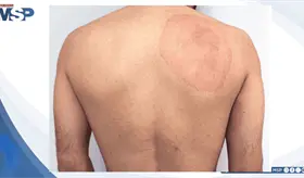 Manchas que crec&iacute;an tras el ejercicio: As&iacute; se diagnostic&oacute; ti&ntilde;a corporis causada por un hongo com&uacute;n