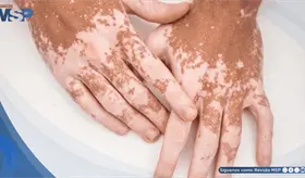 Vitiligo en mujer joven revela posible predisposici&oacute;n a enfermedades autoinmunes