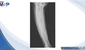 Dolor &oacute;seo progresivo y deformidad de la tibia revelan enfermedad de Paget poliost&oacute;tica en adulto mayor