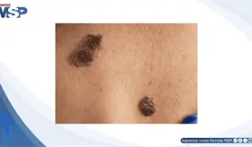Melanoma invasivo: el "lunar" que creci&oacute; durante 10 meses y ya hab&iacute;a comprometido los ganglios