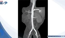 Hipertensi&oacute;n renovascular por estenosis de la arteria renal: causa detr&aacute;s de una crisis hipertensiva