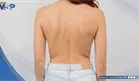 Escoliosis en adolescencia: estudios revelan impacto en la autoestima y frecuencia de alteraci&oacute;n visual