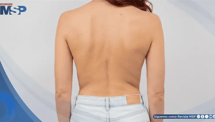 Escoliosis en adolescencia: estudios revelan impacto en la autoestima y frecuencia de alteración visual Escoliosis en adolescencia: estudios revelan impacto en la autoestima y frecuencia de alteración visual
