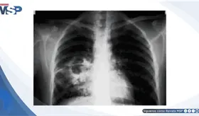 Tuberculosis pulmonar: hallazgos cl&iacute;nicos, microbiol&oacute;gicos y radiol&oacute;gicos en paciente de 38 a&ntilde;os