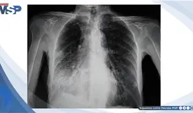 Fiebre, tos y dificultad respiratoria: neumon&iacute;a neumoc&oacute;cica en adulto mayor con comorbilidades