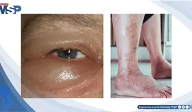 Edema progresivo y aumento de peso revelan s&iacute;ndrome nefr&oacute;tico asociado a diabetes mal controlada