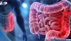 Colitis Ulcerosa: Tofacitinib mostr&oacute; el beneficio cl&iacute;nico m&aacute;s duradero tras fracaso de terapias anti-TNF