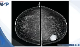 Mujer de 52 a&ntilde;os consulta por masa mamaria y es diagnosticada con c&aacute;ncer de mama estadio IIB
