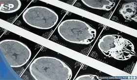 Hasta el 45% del riesgo de demencia podr&iacute;a prevenirse con cambios en el estilo de vida, seg&uacute;n la OMS
