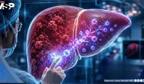 Met&aacute;stasis hep&aacute;tica por c&aacute;ncer de colon: nueva investigaci&oacute;n evalua terapia con c&eacute;lulas madre