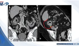Anemia, cansancio y p&eacute;rdida de peso revelaron un c&aacute;ncer de colon en un adulto mayor