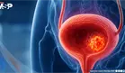 Sangre en la orina: la se&ntilde;al temprana que podr&iacute;a acelerar el diagn&oacute;stico del c&aacute;ncer de vejiga