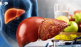 Cirrosis hep&aacute;tica: las se&ntilde;ales de alerta y los factores que aumentan el riesgo de esta enfermedad