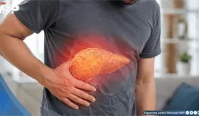 H&iacute;gado graso no alcoh&oacute;lico: el cansancio persistente y el dolor abdominal, se&ntilde;ales de alerta