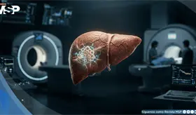 Carcinoma hepatocelular: el tipo m&aacute;s com&uacute;n de c&aacute;ncer de h&iacute;gado puede pasar a&ntilde;os sin s&iacute;ntomas